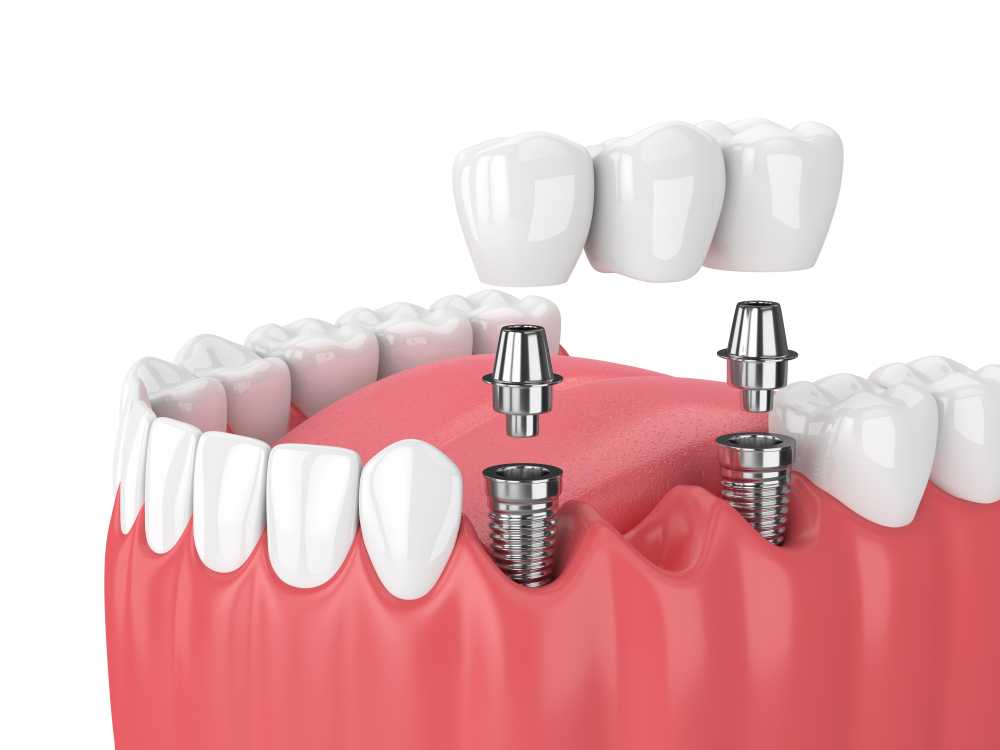 dental implants leads